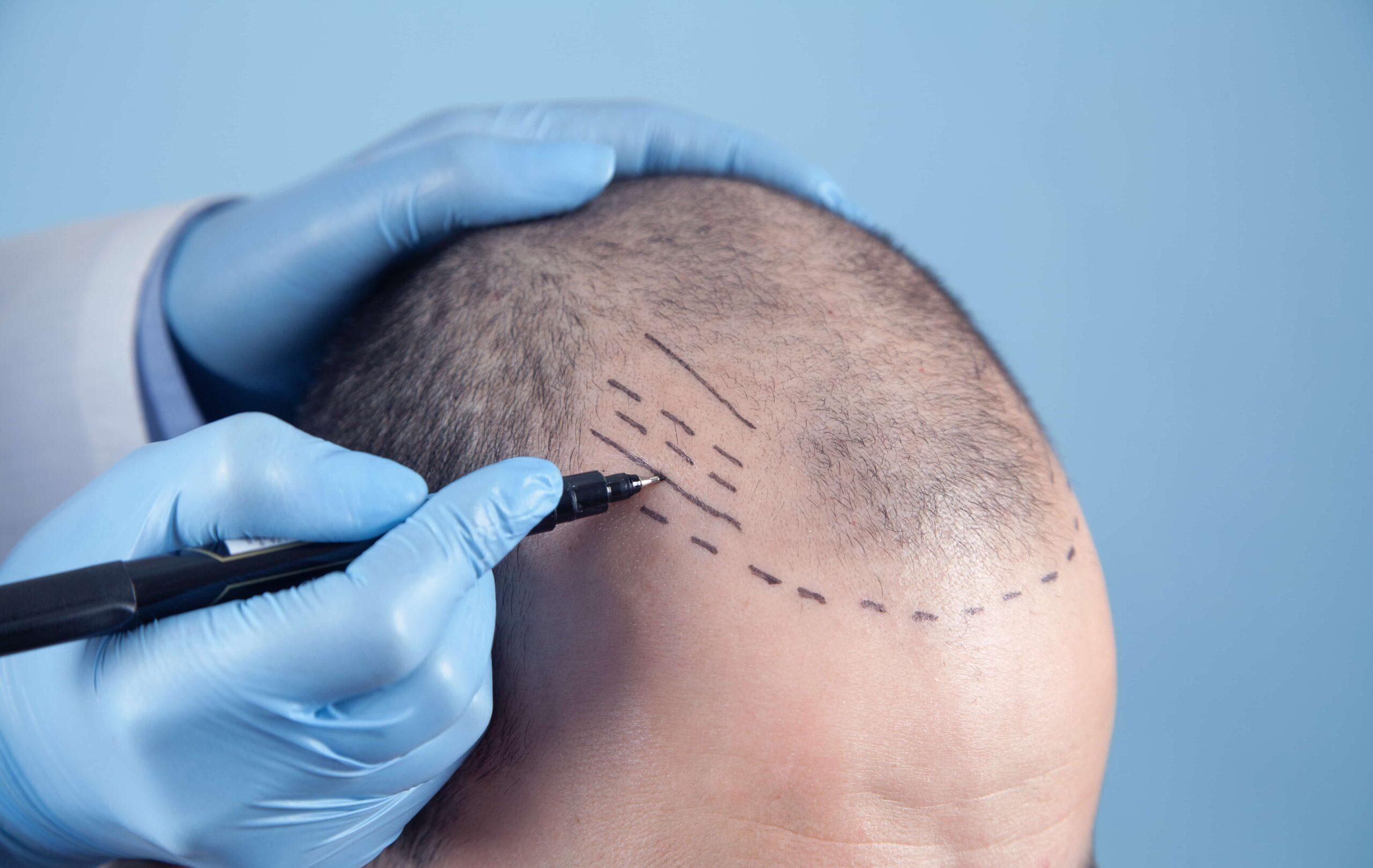La compétence avant tout : ce que cache parfois un bas prix des implants capillaires